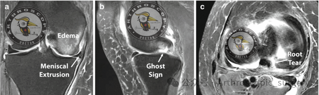 【它山之石】国际专家共识：内侧半月板根部撕裂的诊断、治疗和康复（2025年）