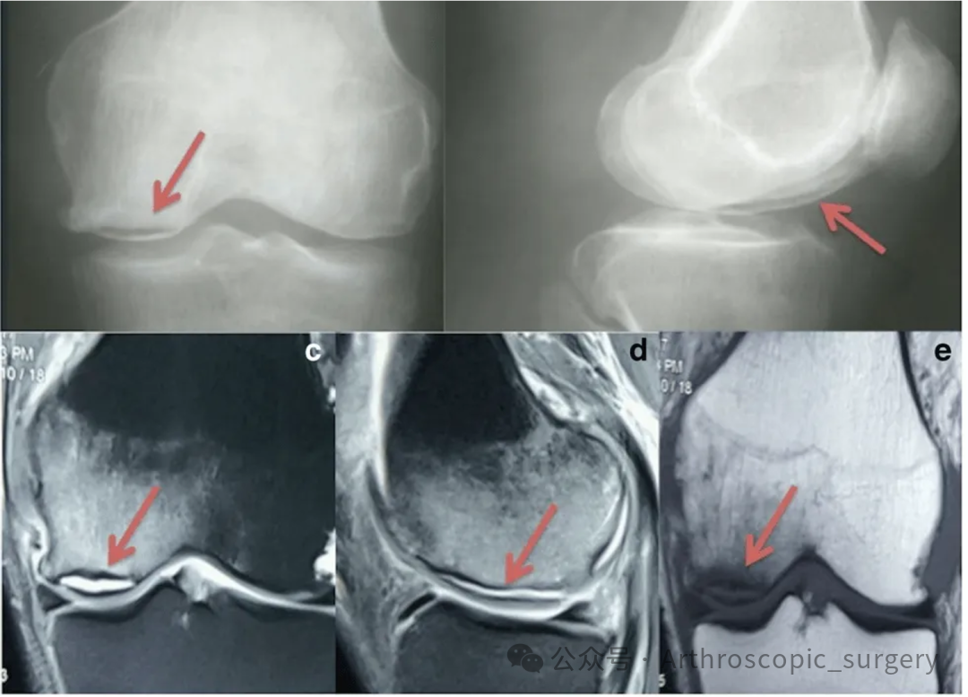 【它山之石】国际专家共识：内侧半月板根部撕裂的诊断、治疗和康复（2025年）