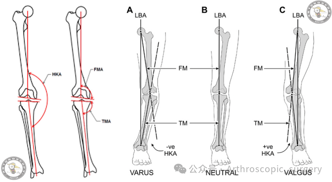 【它山之石】国际专家共识：内侧半月板根部撕裂的诊断、治疗和康复（2025年）