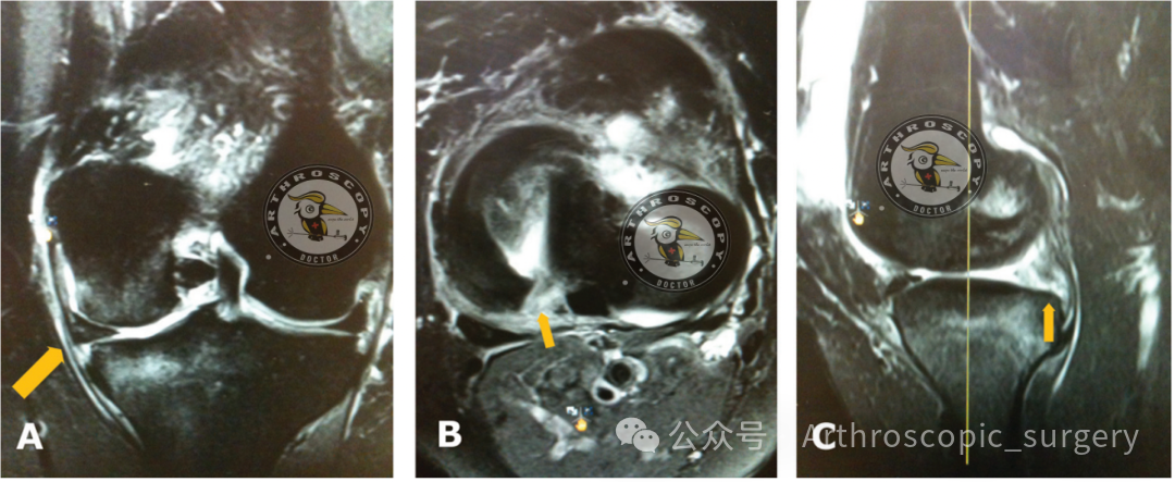 【它山之石】国际专家共识：内侧半月板根部撕裂的诊断、治疗和康复（2025年）
