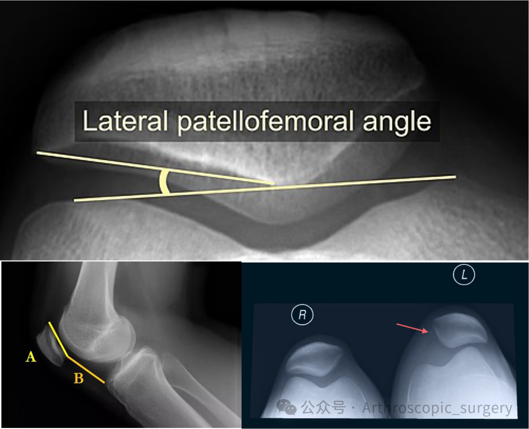 首次髌骨脱位(FTPD)的处理：ESSKA2024专家共识(一)