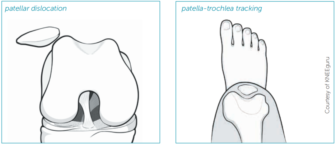 首次髌骨脱位(FTPD)的处理：ESSKA2024专家共识(一)