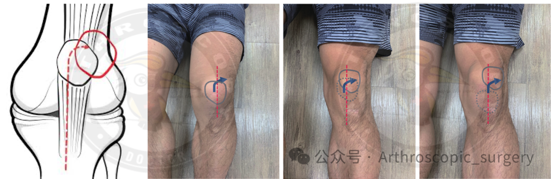 首次髌骨脱位(FTPD)的处理：ESSKA2024专家共识(一)