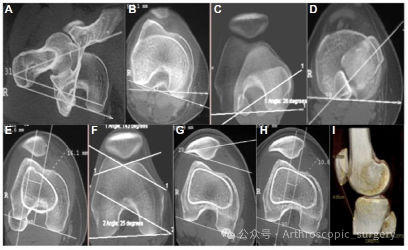 首次髌骨脱位(FTPD)的处理：ESSKA2024专家共识(一)
