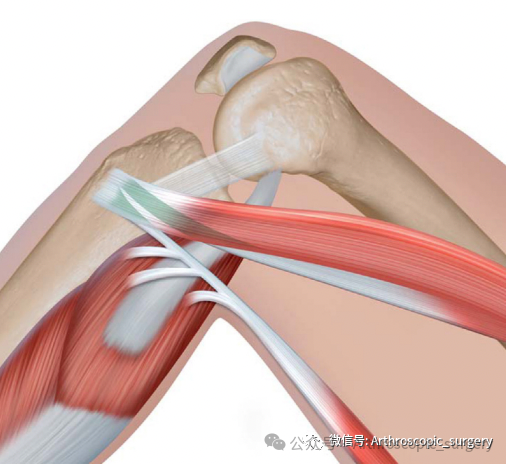 手术技术｜韧带重建技巧：腘绳肌取腱
