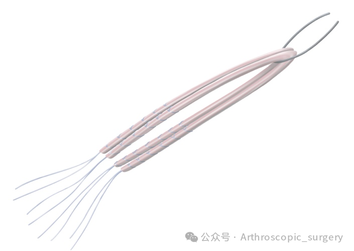 手术技术｜韧带重建技巧：腘绳肌取腱