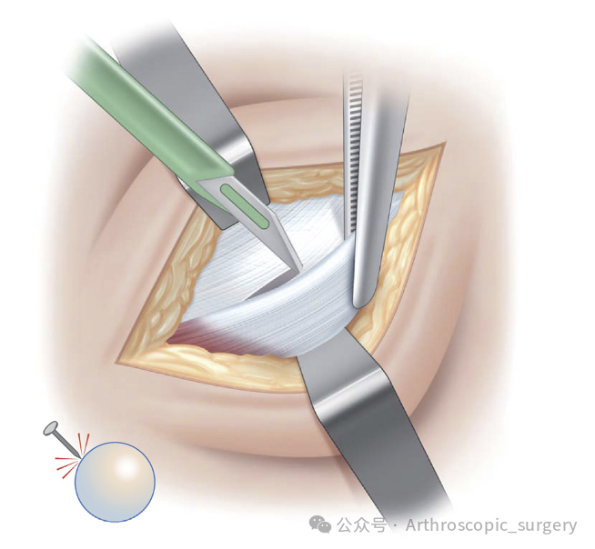 手术技术｜韧带重建技巧：腘绳肌取腱