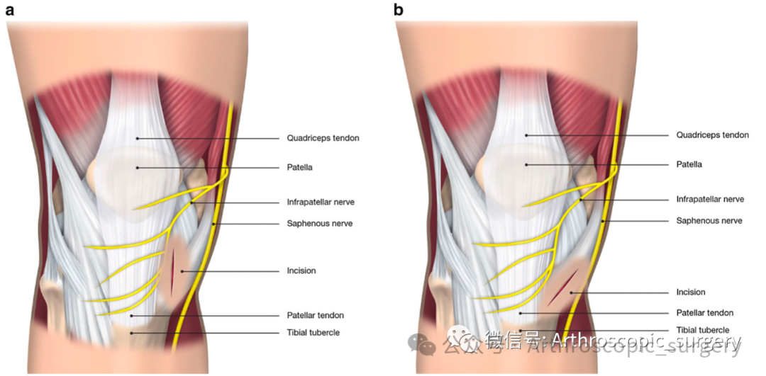手术技术｜韧带重建技巧：腘绳肌取腱