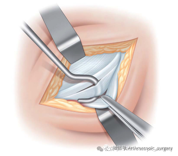 手术技术｜韧带重建技巧：腘绳肌取腱