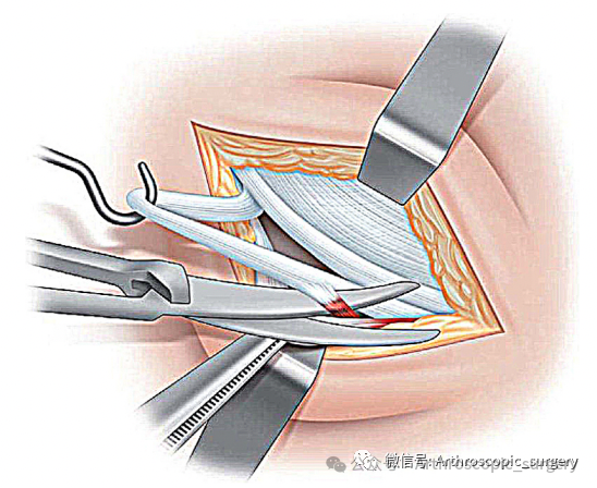 手术技术｜韧带重建技巧：腘绳肌取腱