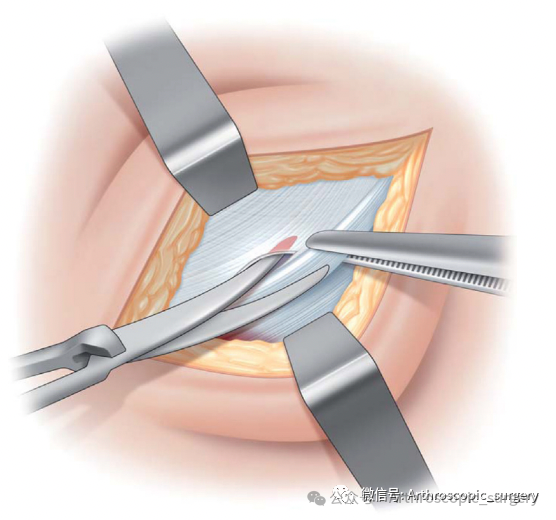 手术技术｜韧带重建技巧：腘绳肌取腱