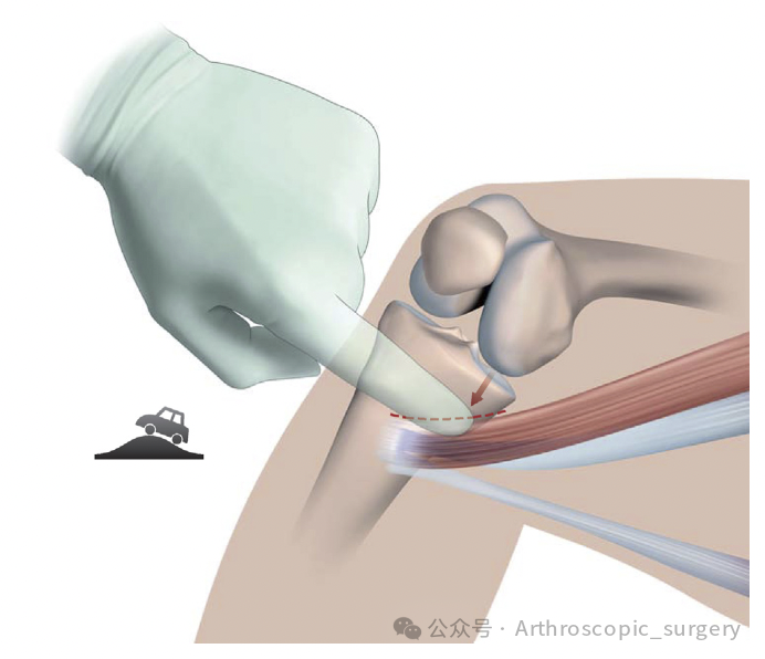 手术技术｜韧带重建技巧：腘绳肌取腱