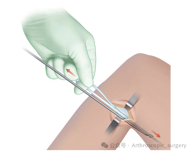 手术技术｜韧带重建技巧：腘绳肌取腱