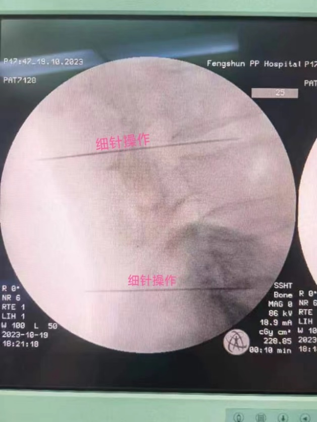 臭氧仪治疗什么【新技术】我院引进德国进口临床臭氧治疗仪：原来有些椎间盘突出，“打针”臭氧也能治疗_https://www.jmylbn.com_新闻资讯_第8张
