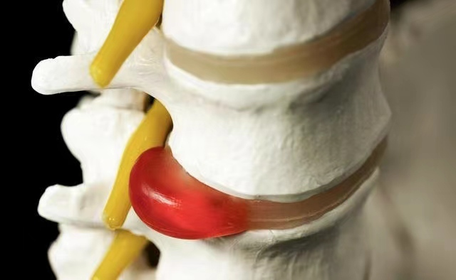 臭氧仪治疗什么【新技术】我院引进德国进口临床臭氧治疗仪：原来有些椎间盘突出，“打针”臭氧也能治疗_https://www.jmylbn.com_新闻资讯_第10张