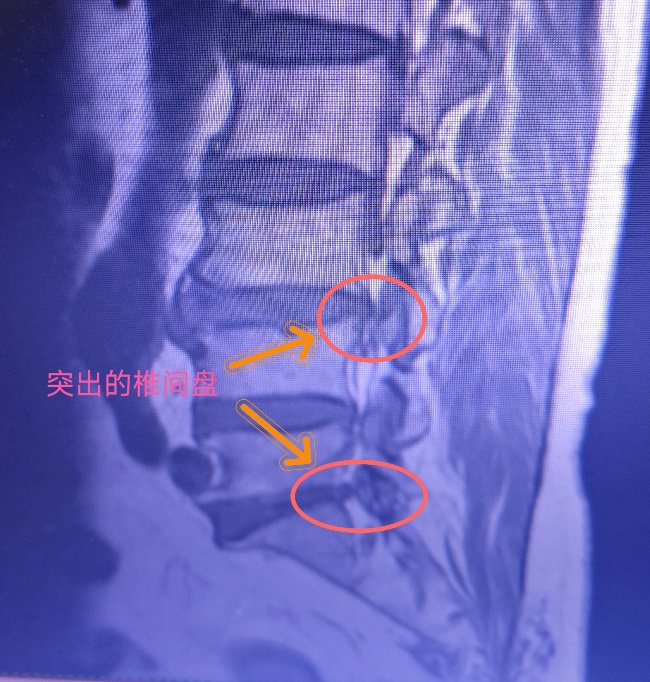 臭氧仪治疗什么【新技术】我院引进德国进口临床臭氧治疗仪：原来有些椎间盘突出，“打针”臭氧也能治疗_https://www.jmylbn.com_新闻资讯_第7张
