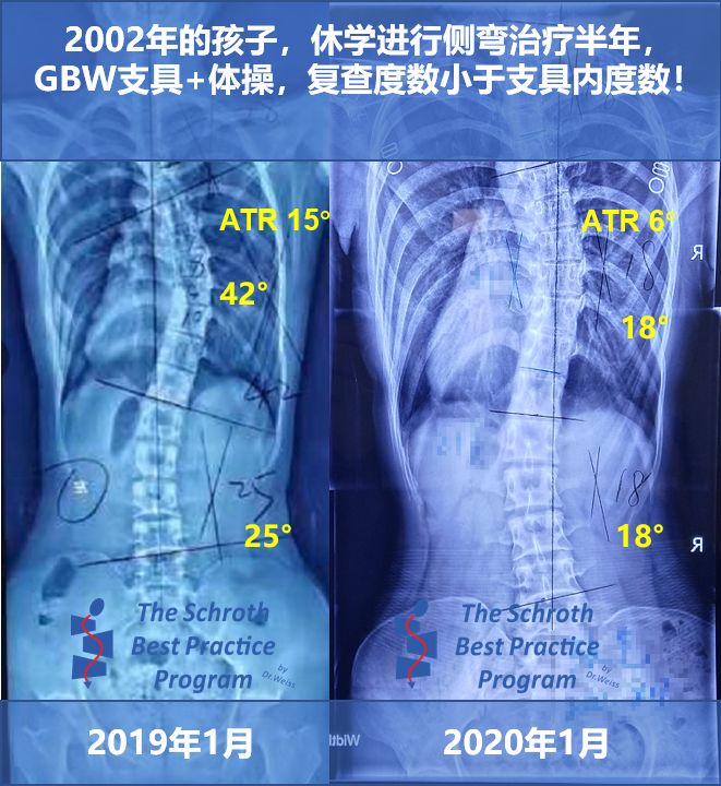 支具+体操案例，02年侧弯女孩努力一年度数减半！