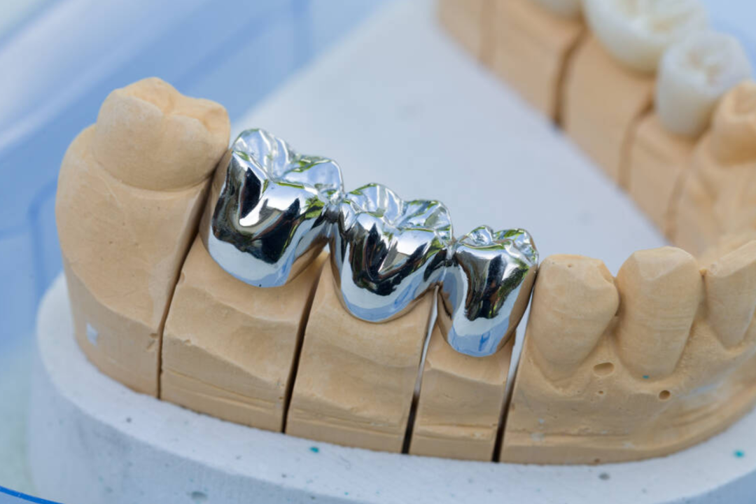 种植牙大降价，种植牙冠要如何选择？(种植牙的牙冠哪个比较好)