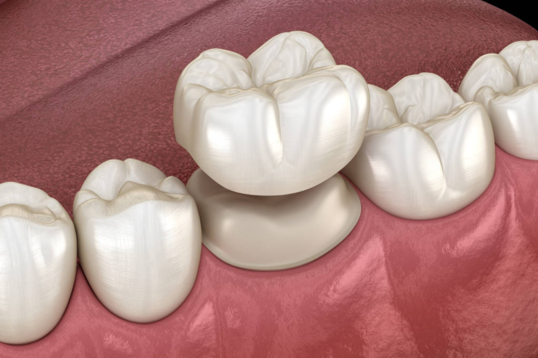 牙胶尖什么颜色港闸医院爱尔口腔｜牙齿发黑很难看？可能是牙髓坏死_https://www.jmylbn.com_新闻资讯_第4张