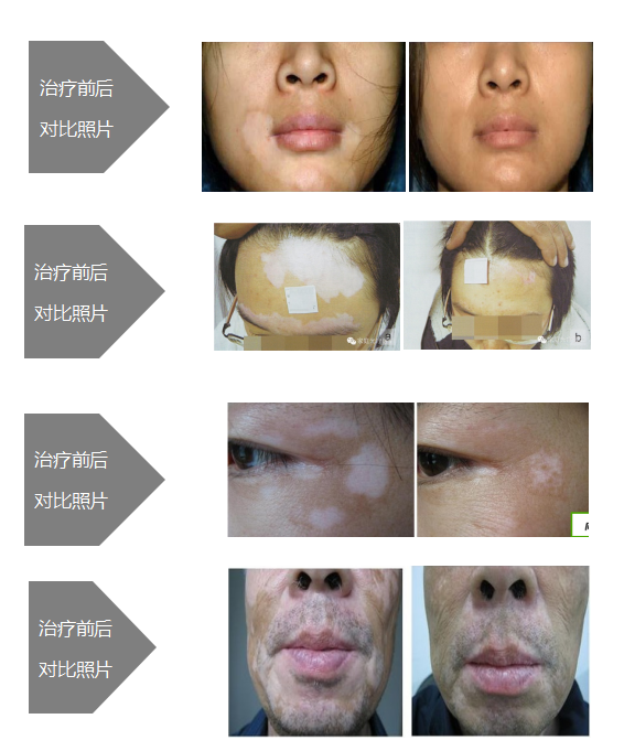 4006B光疗怎么用【新设备 新运用】治疗白癜风的308紫外线光疗仪哪里有？快来第十师北屯市总医院！_https://www.jmylbn.com_新闻资讯_第9张