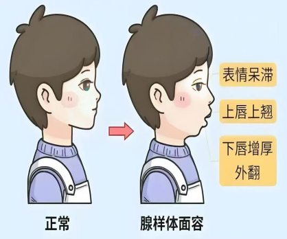 cpap鼻塞怎么固定儿科科普｜孩子打鼾？可能是“睡眠呼吸暂停”在作怪！_https://www.jmylbn.com_新闻资讯_第5张