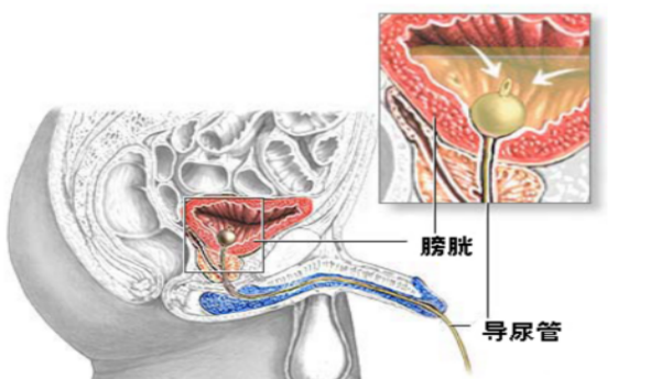 为什么要引流尿袋留置尿管你需要知道的事_https://www.jmylbn.com_新闻资讯_第3张