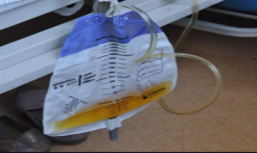 为什么要引流尿袋留置尿管你需要知道的事_https://www.jmylbn.com_新闻资讯_第6张