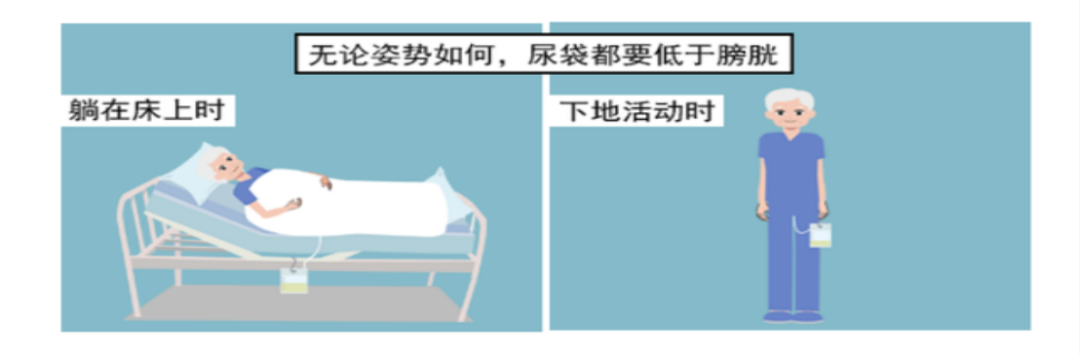 为什么要引流尿袋留置尿管你需要知道的事_https://www.jmylbn.com_新闻资讯_第5张