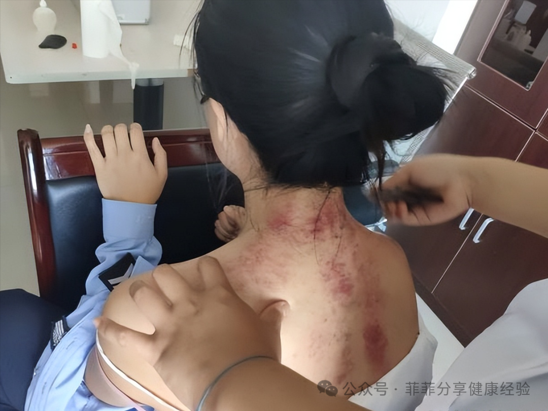 用刮痧板自己怎么刮脸女子早起刮痧板刮脸，坚持了一年去医院体检，医生大为惊叹_https://www.jmylbn.com_新闻资讯_第6张