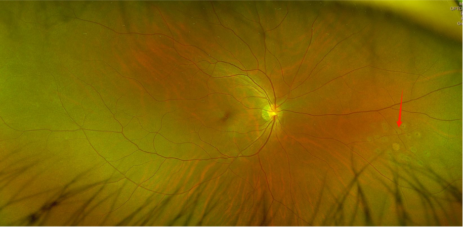 眼底激光机有什么牌子眼底检查揪出视网膜隐患，激光手术为高度近视患者筑牢视力防护墙_https://www.jmylbn.com_新闻资讯_第5张