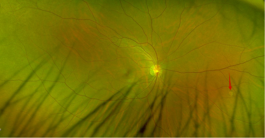 眼底激光机有什么牌子眼底检查揪出视网膜隐患，激光手术为高度近视患者筑牢视力防护墙_https://www.jmylbn.com_新闻资讯_第4张