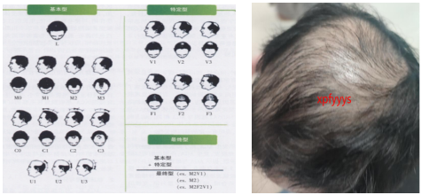 霞浦县妇幼保健院皮肤科还在为脱发烦恼吗？