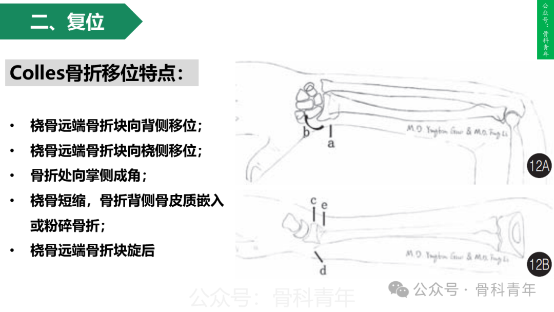 积水潭教程：桡骨远端骨折闭合整复石膏固定操作流程
