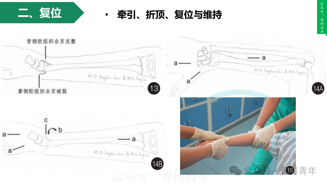 积水潭教程：桡骨远端骨折闭合整复石膏固定操作流程