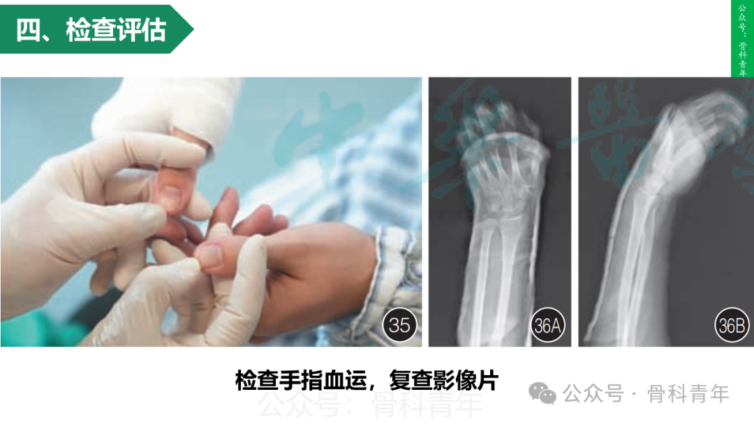 积水潭教程：桡骨远端骨折闭合整复石膏固定操作流程