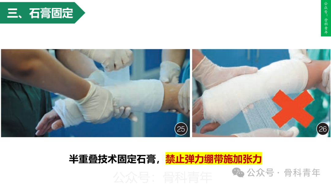 积水潭教程：桡骨远端骨折闭合整复石膏固定操作流程
