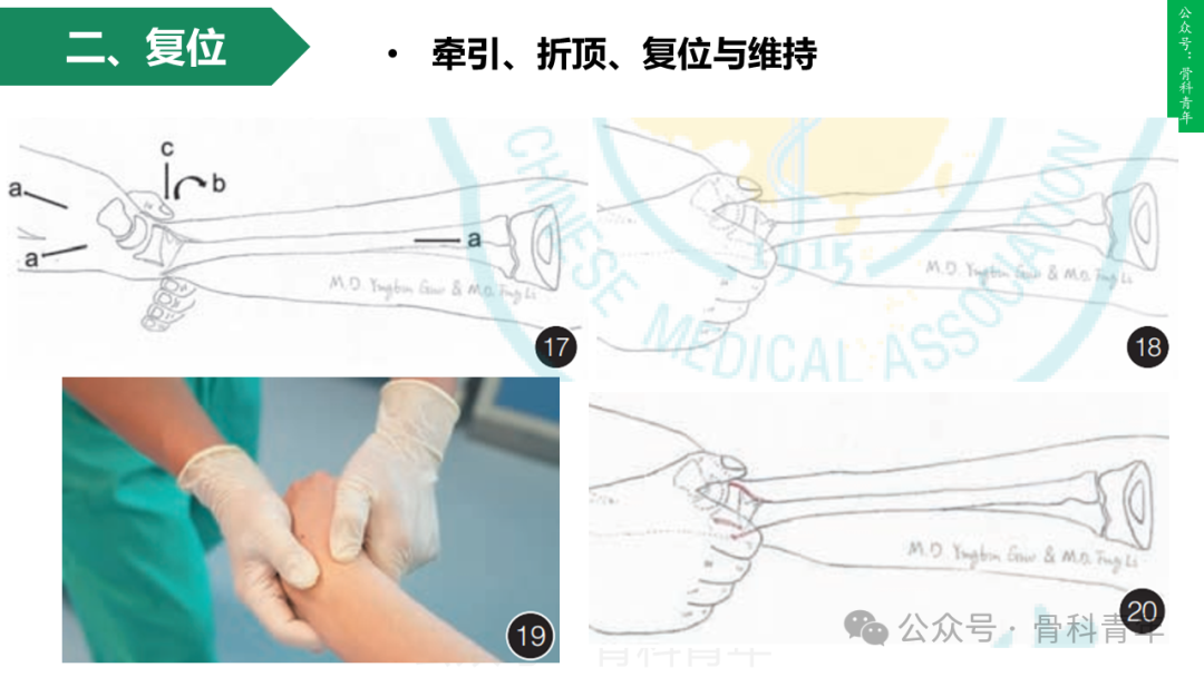 积水潭教程：桡骨远端骨折闭合整复石膏固定操作流程