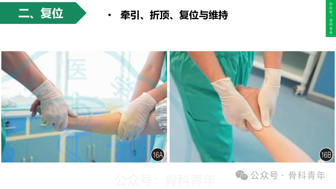 积水潭教程：桡骨远端骨折闭合整复石膏固定操作流程