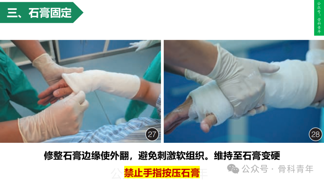 积水潭教程：桡骨远端骨折闭合整复石膏固定操作流程