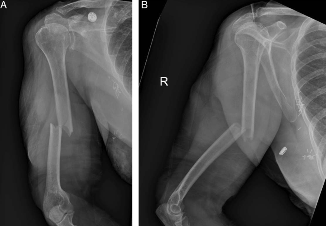 “骑缝钉”辅助固定骨折：锦上添花还是画蛇添足？