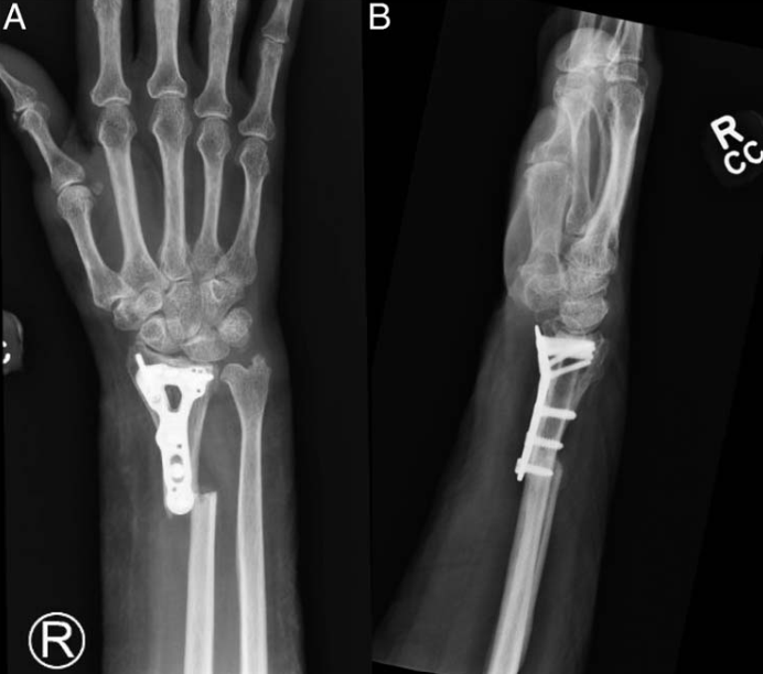 “骑缝钉”辅助固定骨折：锦上添花还是画蛇添足？