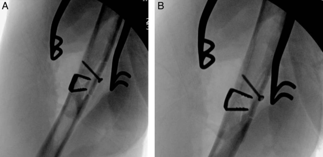 “骑缝钉”辅助固定骨折：锦上添花还是画蛇添足？