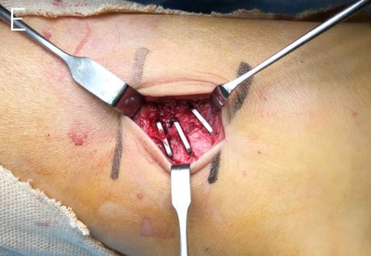 “骑缝钉”辅助固定骨折：锦上添花还是画蛇添足？