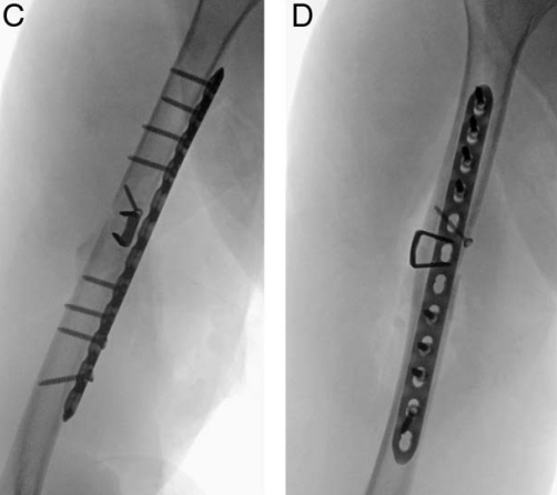 “骑缝钉”辅助固定骨折：锦上添花还是画蛇添足？