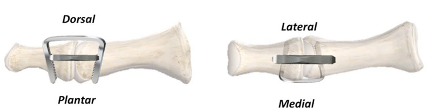 “骑缝钉”辅助固定骨折：锦上添花还是画蛇添足？