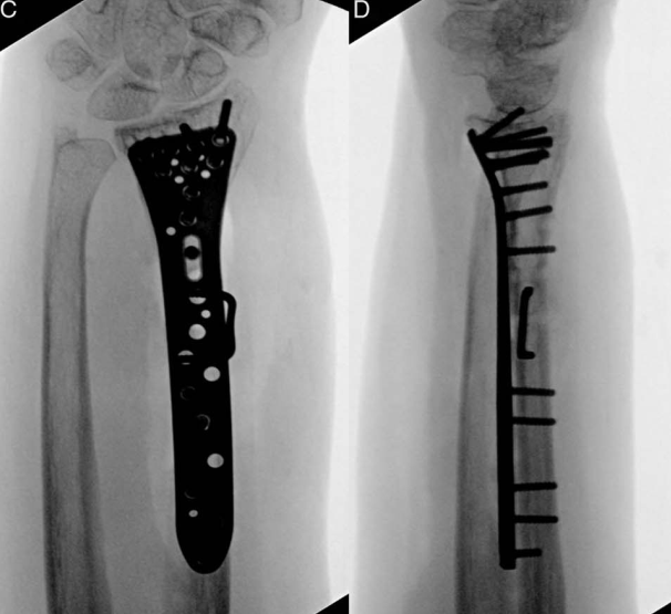 “骑缝钉”辅助固定骨折：锦上添花还是画蛇添足？