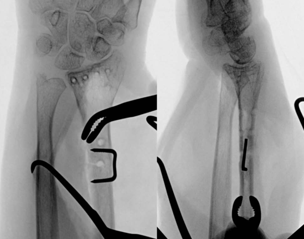 “骑缝钉”辅助固定骨折：锦上添花还是画蛇添足？