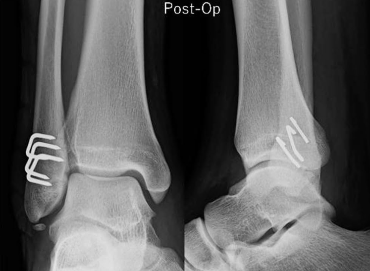 “骑缝钉”辅助固定骨折：锦上添花还是画蛇添足？