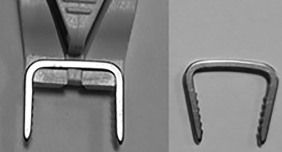 “骑缝钉”辅助固定骨折：锦上添花还是画蛇添足？