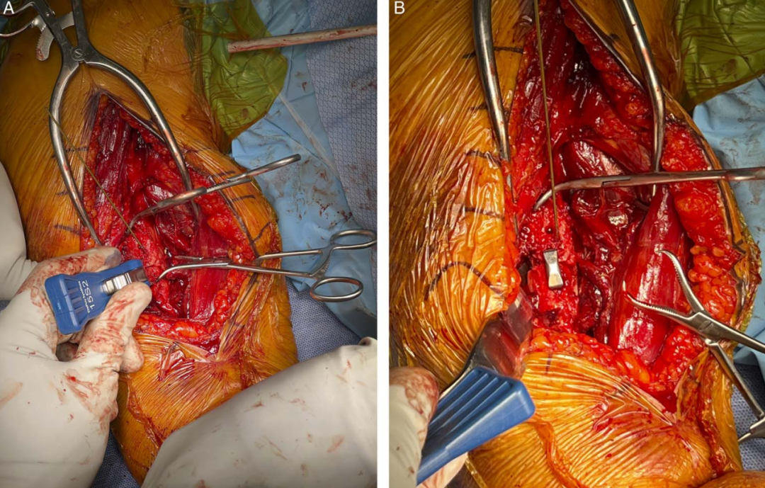 “骑缝钉”辅助固定骨折：锦上添花还是画蛇添足？